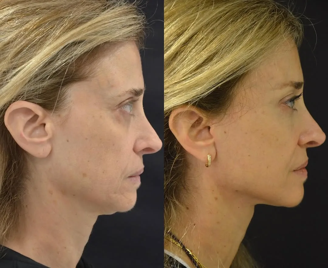 Before and after deep plane facelift — 45-year-old woman, left profile view, 6mo post-op by Dr. Pierre Abi Akl