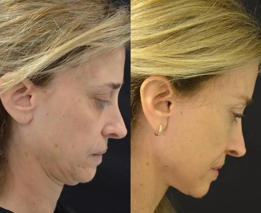 Before and after deep plane facelift — 45-year-old woman, right profile view, 6mo post-op by Dr. Pierre Abi Akl