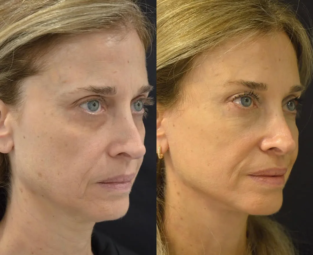 Before and after deep plane facelift — 48-year-old woman, oblique right view, 6mo post-op by Dr. Pierre Abi Akl