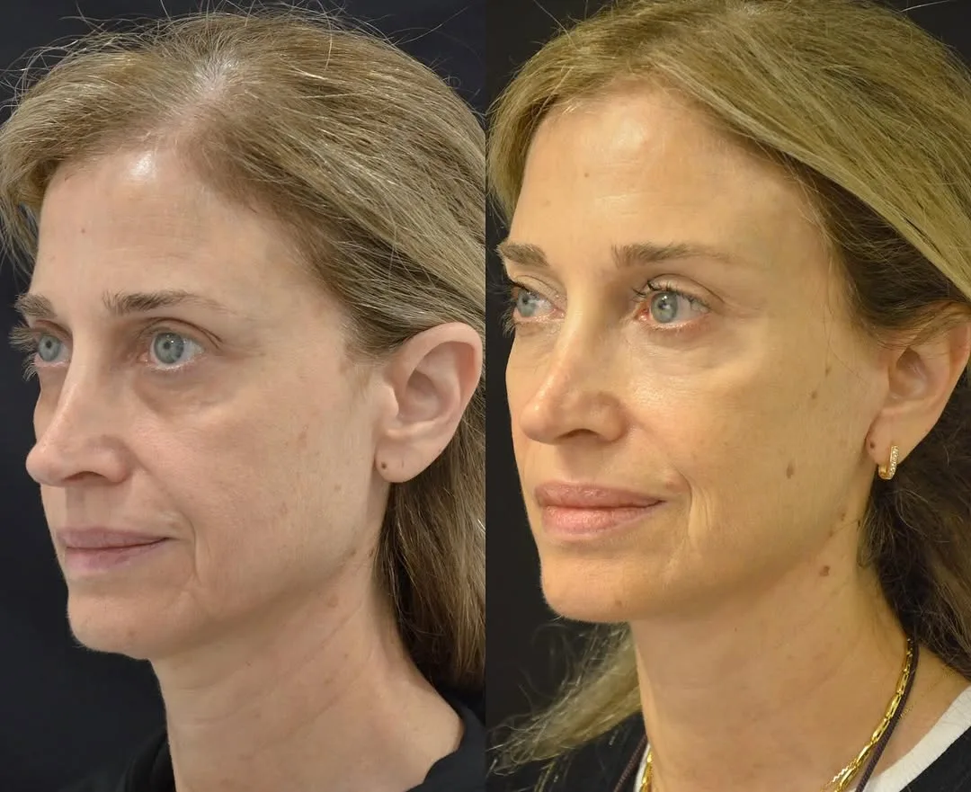 Before and after deep plane facelift — 48-year-old woman, right profile view, 6mo post-op by Dr. Pierre Abi Akl