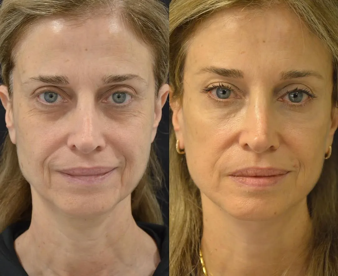 Before and after deep plane facelift — 48-year-old woman, frontal view, 6mo post-op by Dr. Pierre Abi Akl