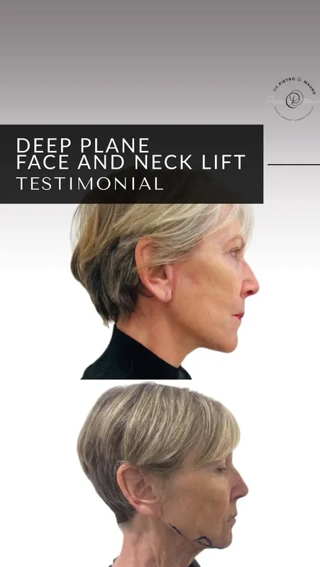 Before and after — Dr. Pietro Di Mauro