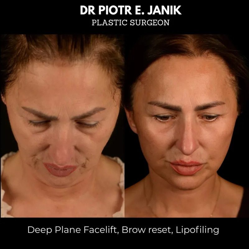 Before and after: Dr. Piotr Janik