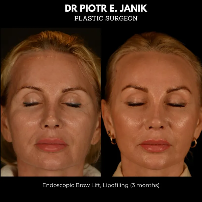 Before and after: Dr. Piotr Janik