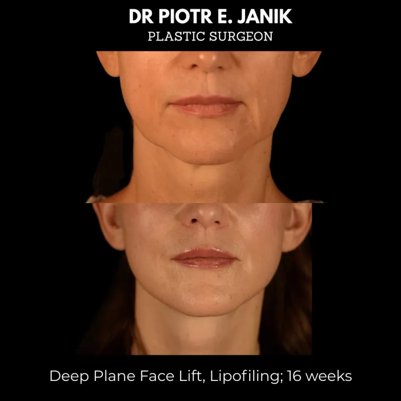 Before and after: Dr. Piotr Janik