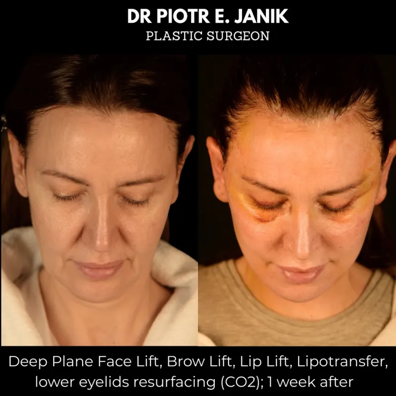 Before and after: Dr. Piotr Janik