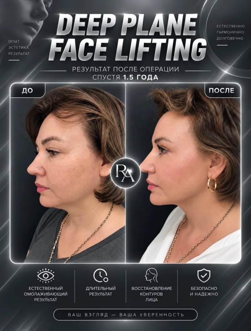 قبل وبعد - Deep Plane Facelift بواسطة د. Радик Ахметов