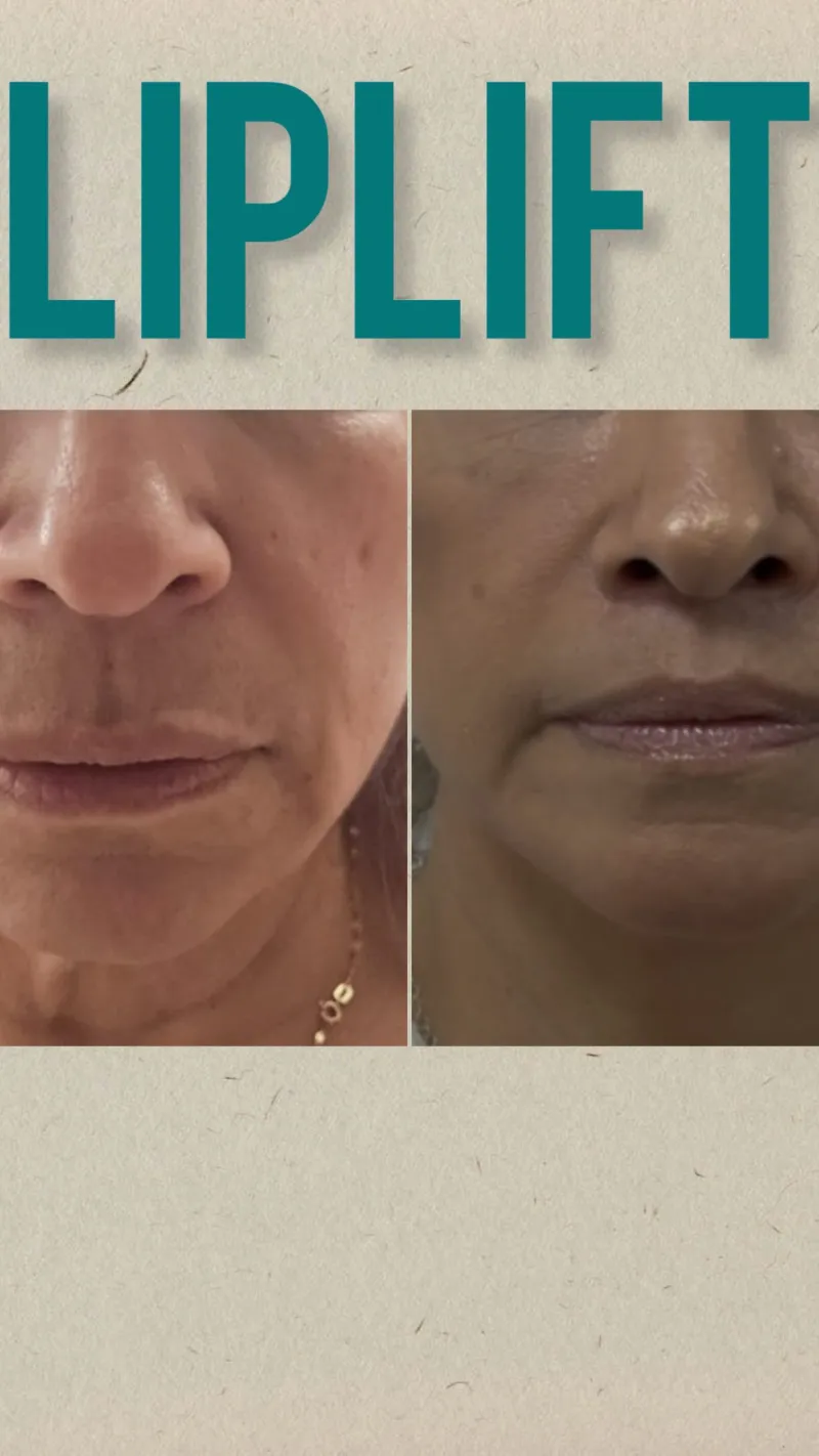 قبل وبعد - Lip Lift بواسطة د. Rafael Arenas