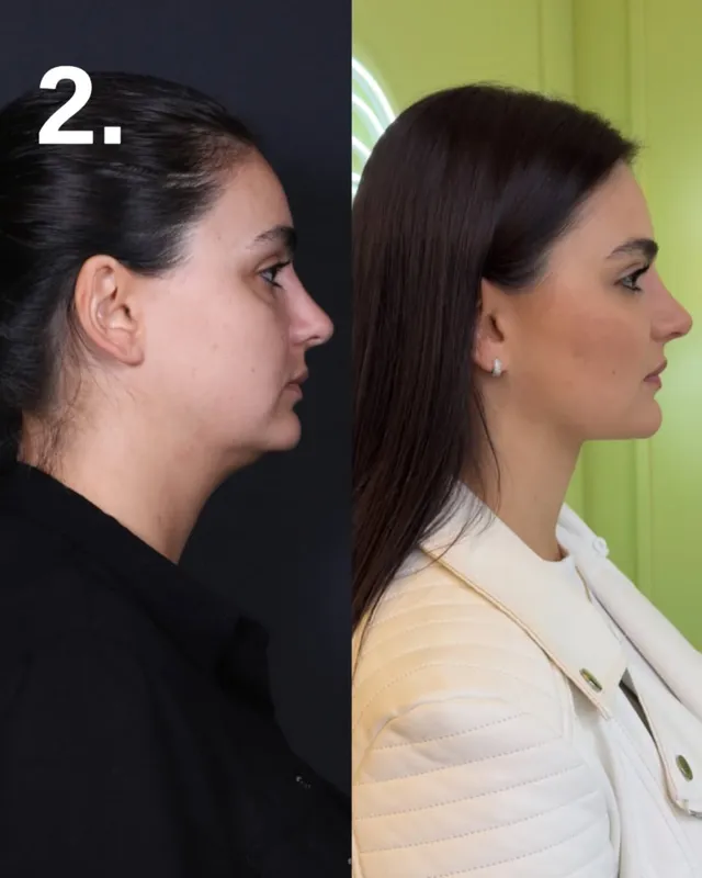 Before and after deep plane facelift, frontal view by Dr. Rafael Evaristo