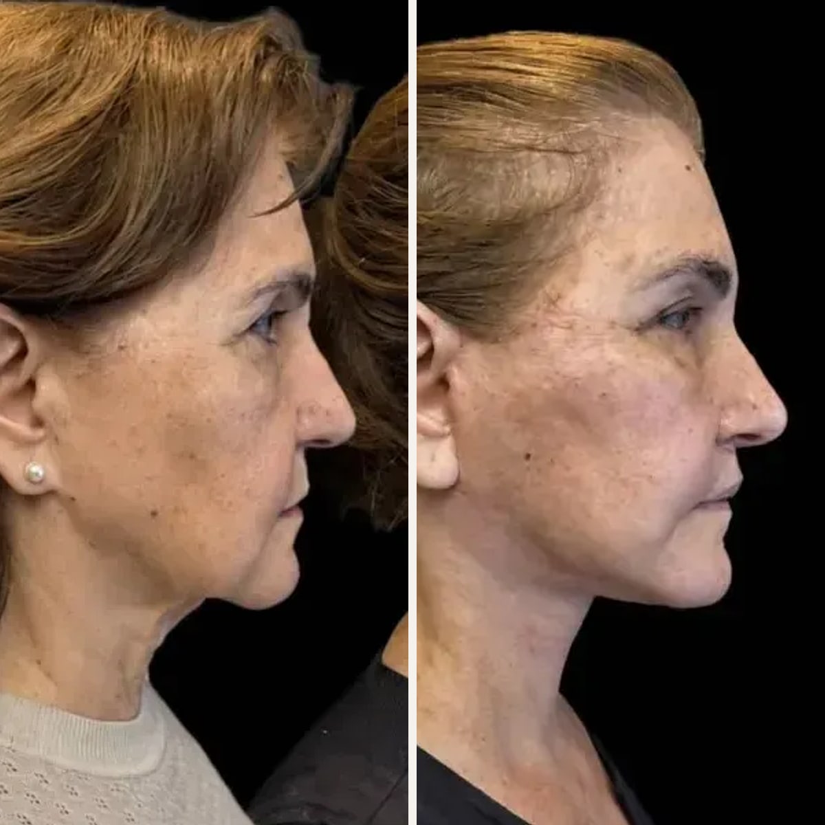 Before and after: Dr. Rafael Meirelles