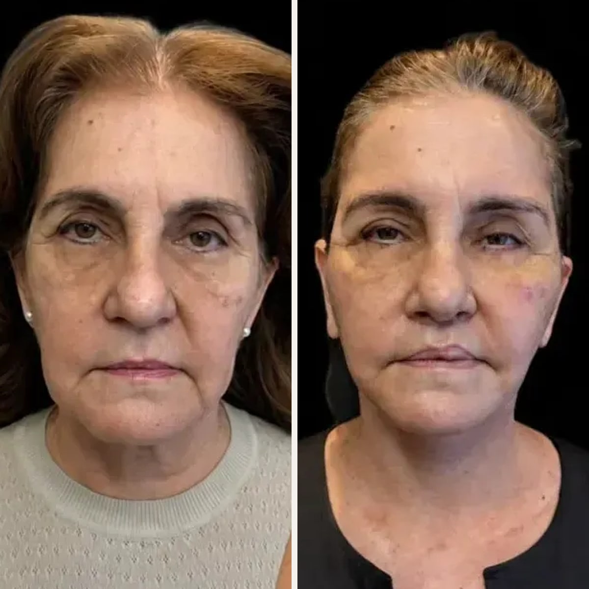 Before and after: Dr. Rafael Meirelles