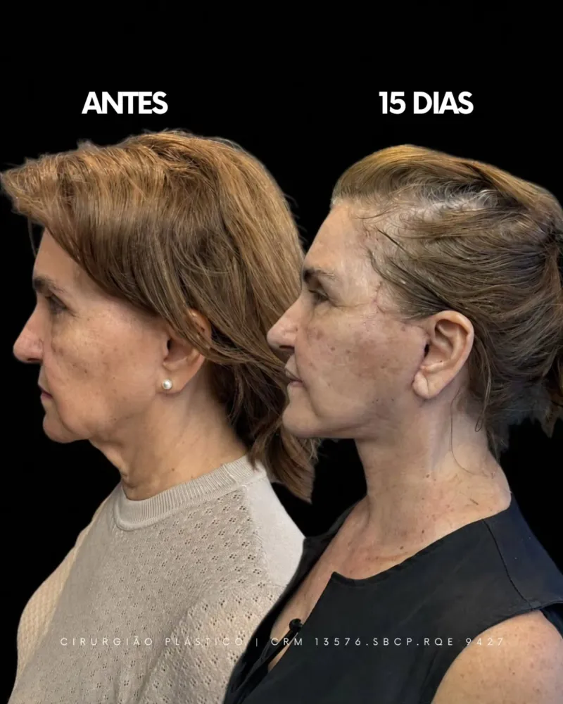 Before and after: Dr. Rafael Meirelles