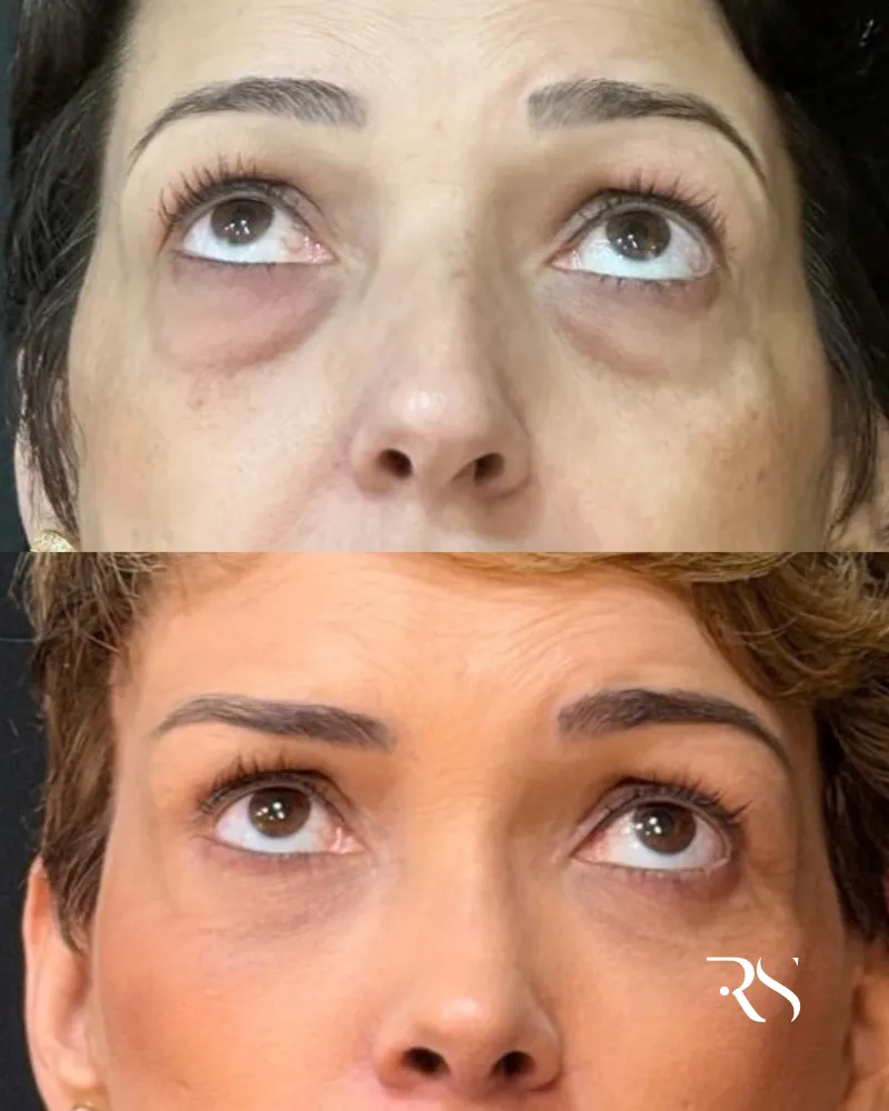 قبل وبعد - Lower Eyelid Surgery بواسطة د. Rafaela Saad