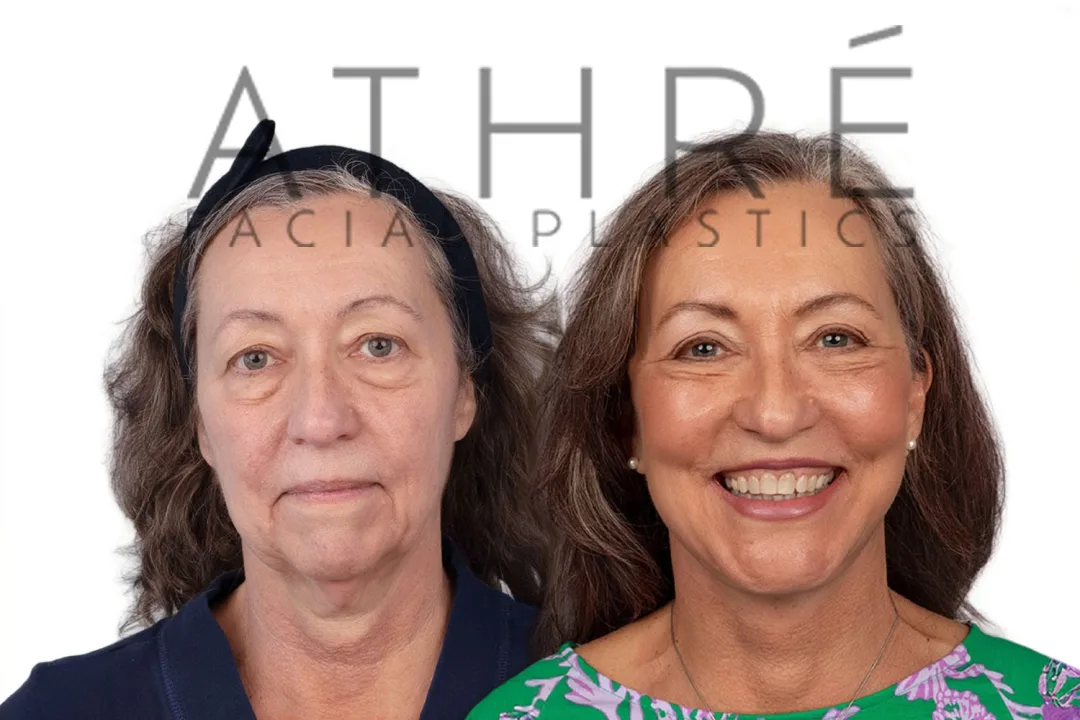 Before and after deep plane facelift — 55-year-old woman, frontal view, 7mo post-op by Dr. Raghu Athre