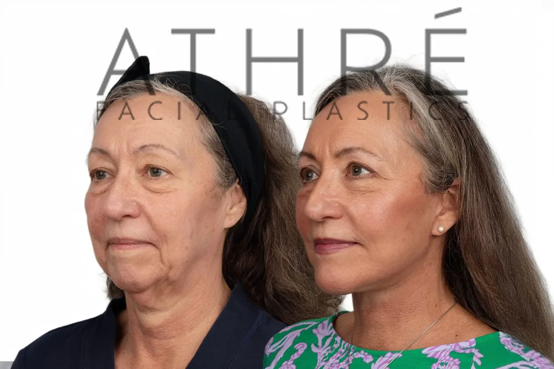 Before and after deep plane facelift — 58-year-old woman, oblique left view, 9mo post-op by Dr. Raghu Athre