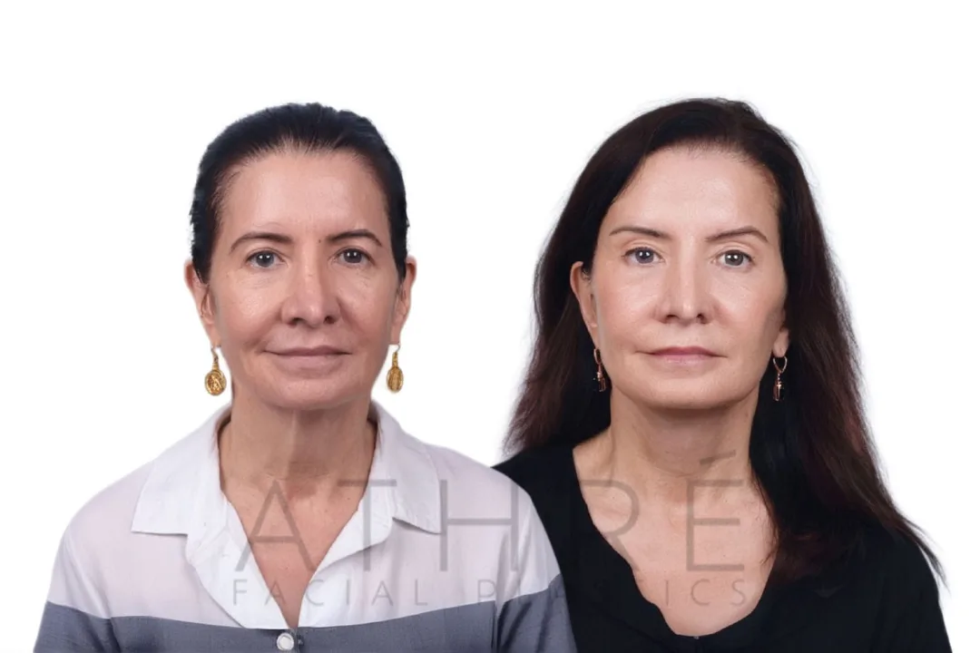 Before and after deep plane facelift — 55-year-old woman, frontal view, 7mo post-op by Dr. Raghu Athre