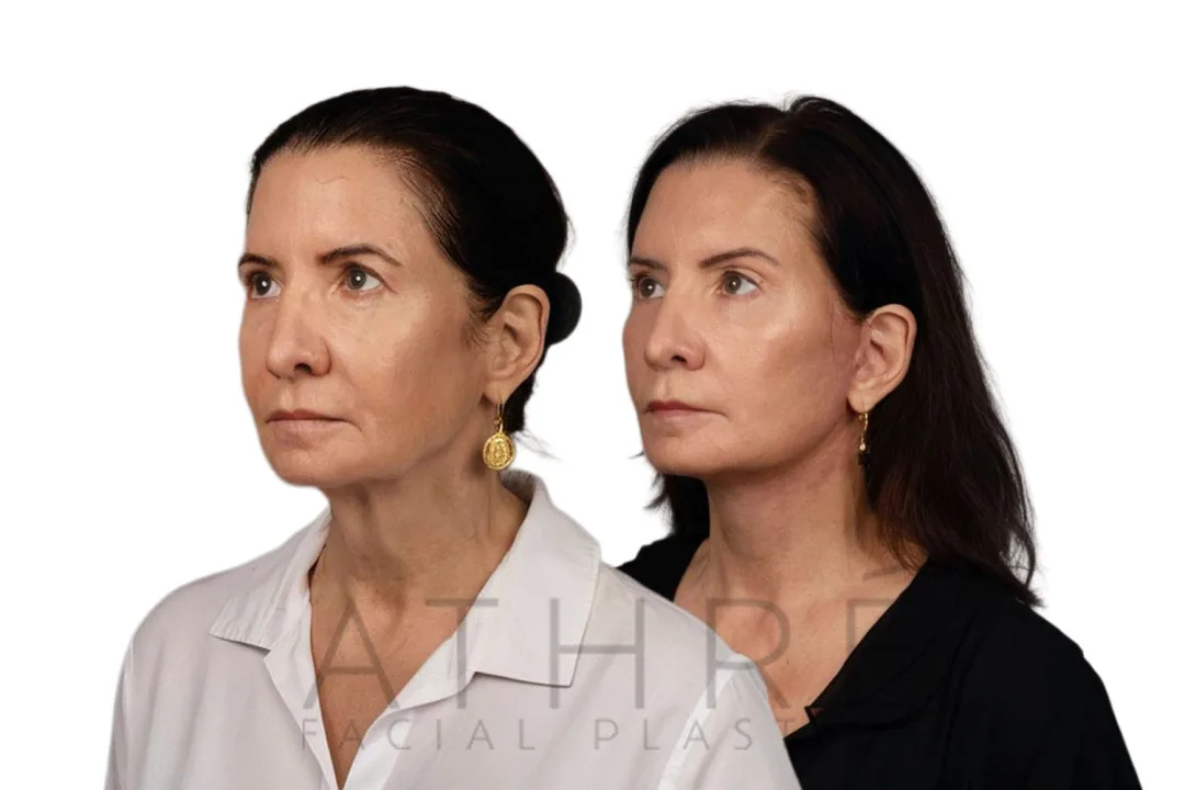 Before and after deep plane facelift — 52-year-old woman, oblique left view, 7mo post-op by Dr. Raghu Athre