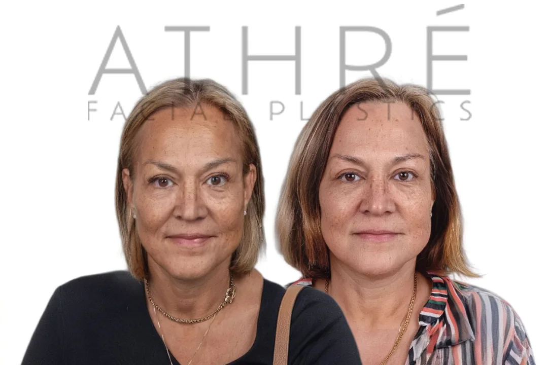 Before and after deep plane facelift — 55-year-old woman, frontal view, 7mo post-op by Dr. Raghu Athre