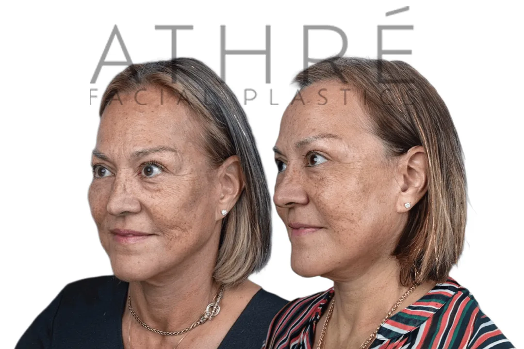 Before and after deep plane facelift — 55-year-old woman, oblique right view, 7mo post-op by Dr. Raghu Athre