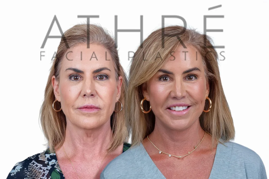 Before and after deep plane facelift — 55-year-old woman, frontal view, 7mo post-op by Dr. Raghu Athre
