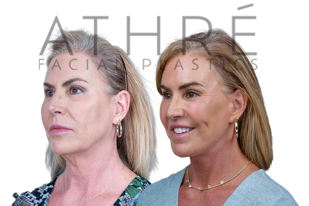 Before and after deep plane facelift — 52-year-old woman, oblique left view, 6mo post-op by Dr. Raghu Athre