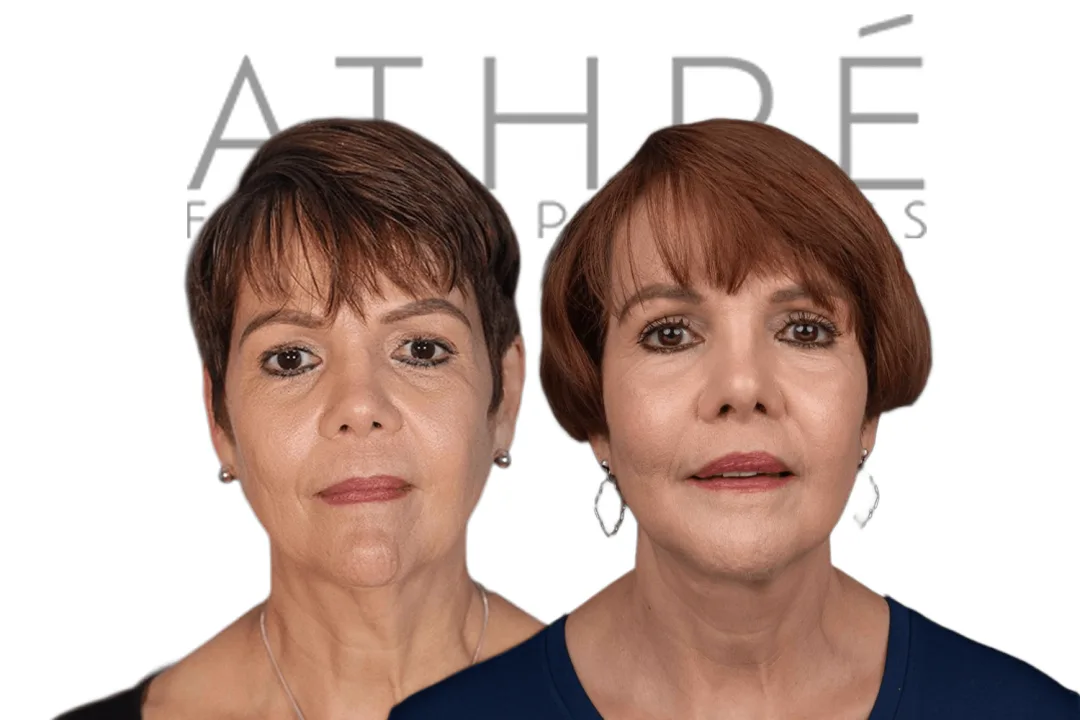 Before and after deep plane facelift — 58-year-old woman, frontal view, 7mo post-op by Dr. Raghu Athre