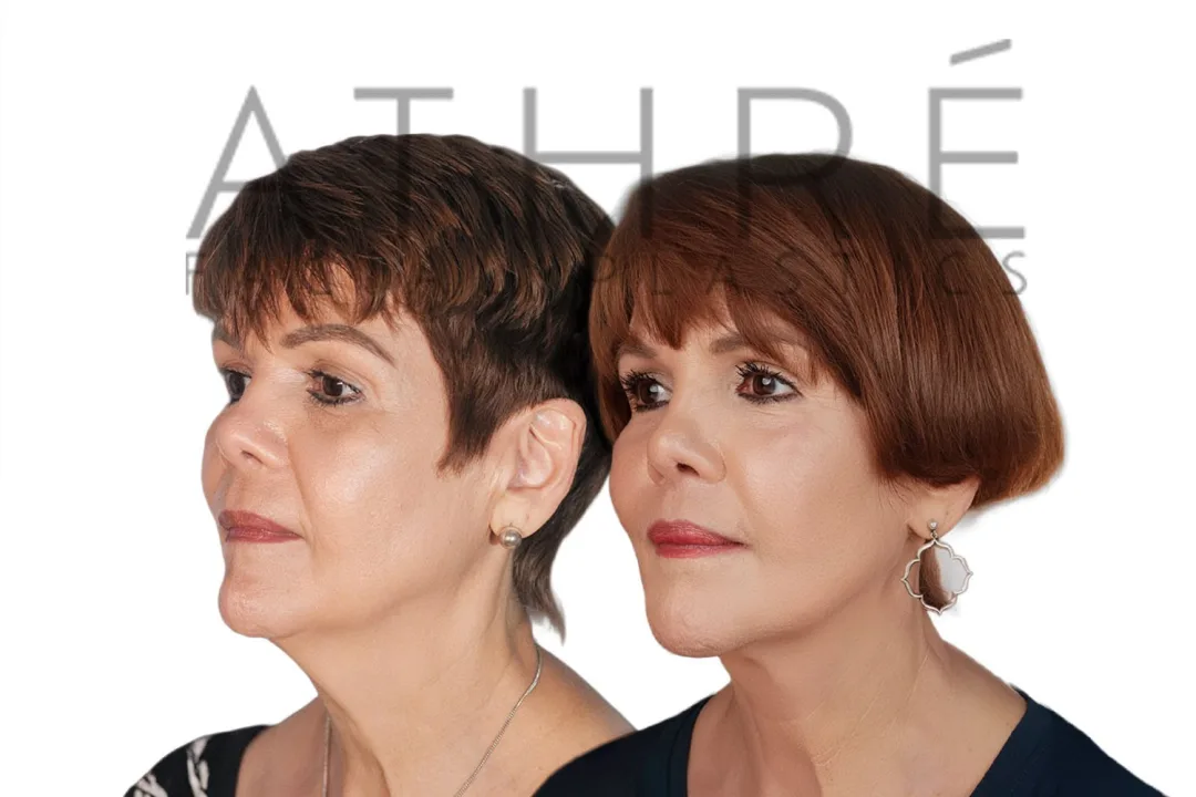 Before and after deep plane facelift — 55-year-old woman, oblique left view, 7mo post-op by Dr. Raghu Athre