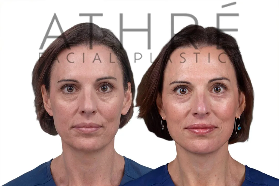 Before and after deep plane facelift — 48-year-old woman, frontal view, 6mo post-op by Dr. Raghu Athre