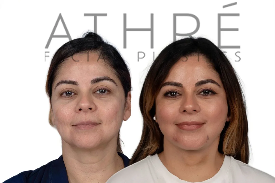 Before and after deep plane facelift — 45-year-old woman, frontal view, 6mo post-op by Dr. Raghu Athre