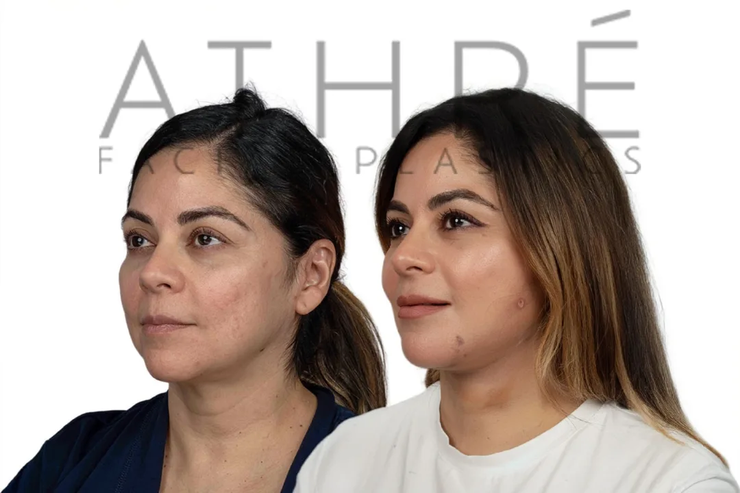 Before and after deep plane facelift — 45-year-old woman, oblique left view, 8mo post-op by Dr. Raghu Athre