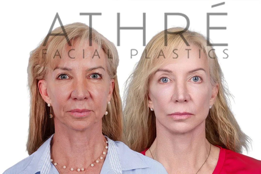 Before and after deep plane facelift — 55-year-old woman, frontal view, 7mo post-op by Dr. Raghu Athre