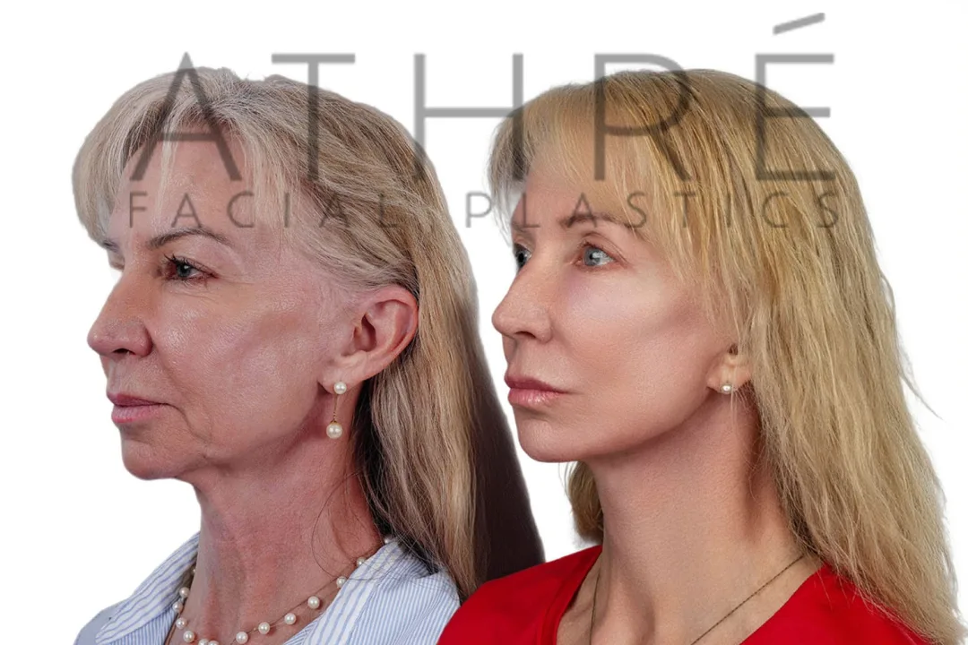 Before and after deep plane facelift — 58-year-old woman, left profile view, 7mo post-op by Dr. Raghu Athre