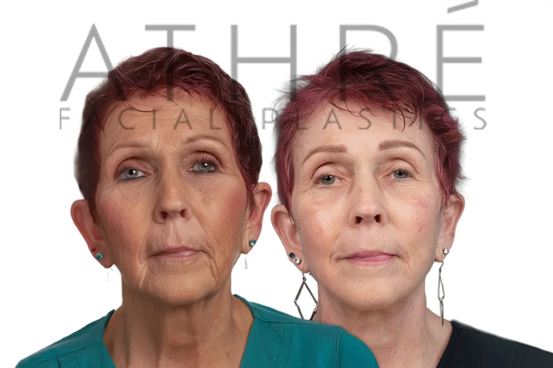 Before and after deep plane facelift — 58-year-old woman, frontal view, 7mo post-op by Dr. Raghu Athre
