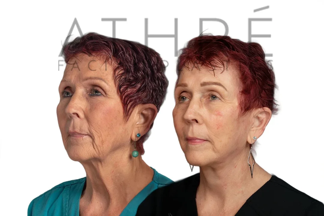 Before and after deep plane facelift — 62-year-old woman, three-quarter view, 6mo post-op by Dr. Raghu Athre