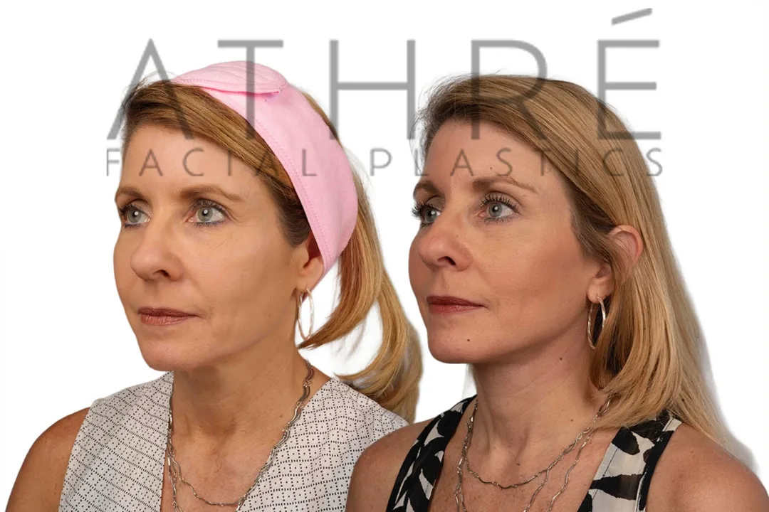 Before and after deep plane facelift — 52-year-old woman, oblique right view, 6mo post-op by Dr. Raghu Athre
