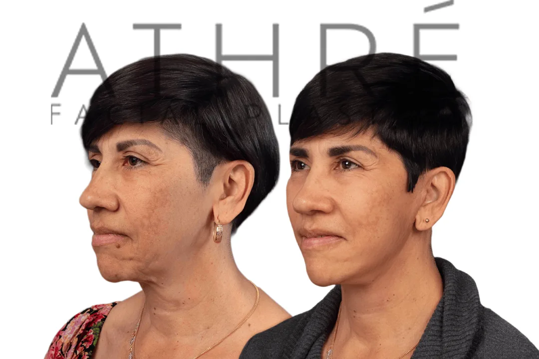 Before and after deep plane facelift — 55-year-old woman, left profile view, 6mo post-op by Dr. Raghu Athre