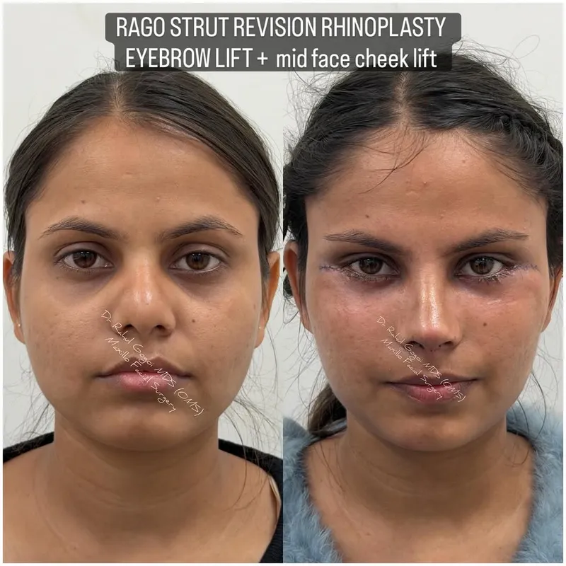 Before and after deep plane facelift, frontal view by Dr. Rahul Gogoi