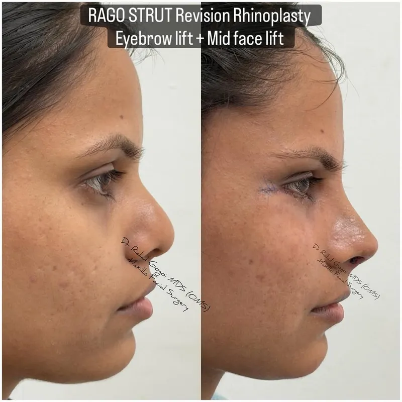 Before and after deep plane facelift, frontal view by Dr. Rahul Gogoi