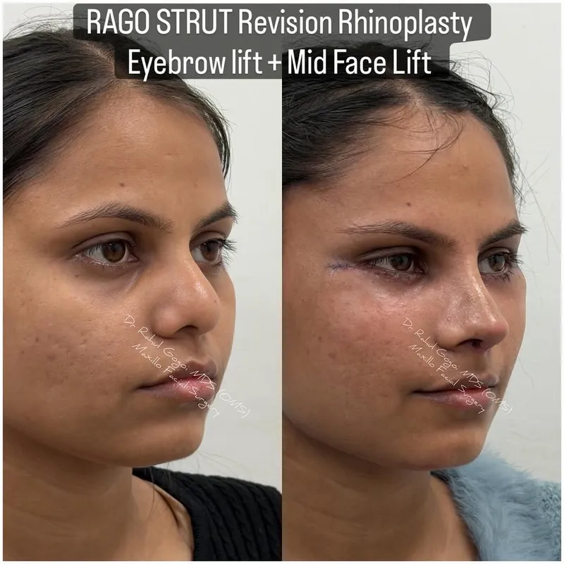 Before and after deep plane facelift, frontal view by Dr. Rahul Gogoi