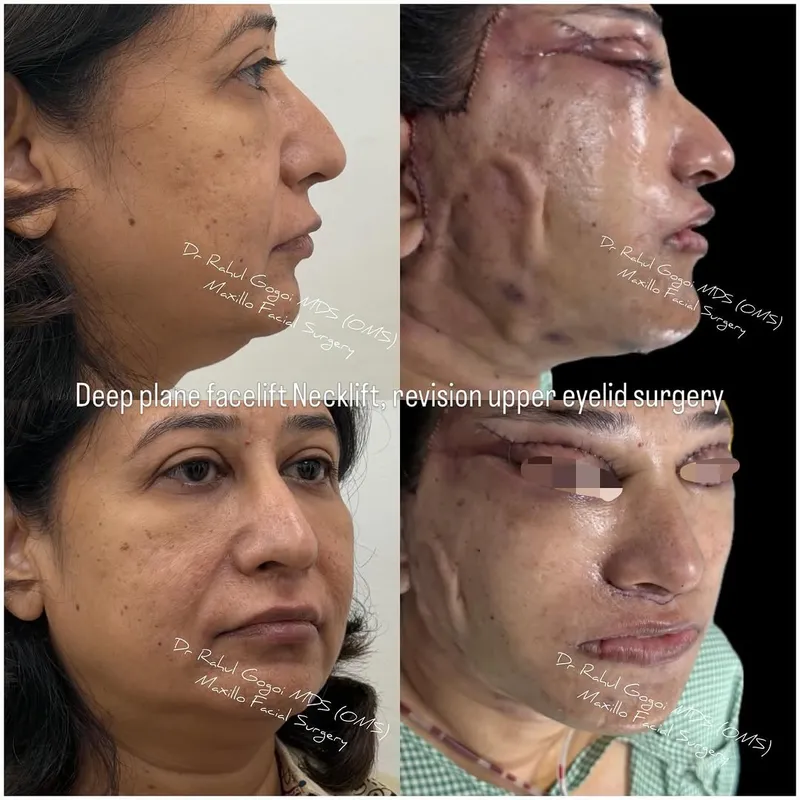 Before and after deep plane facelift, frontal view by Dr. Rahul Gogoi