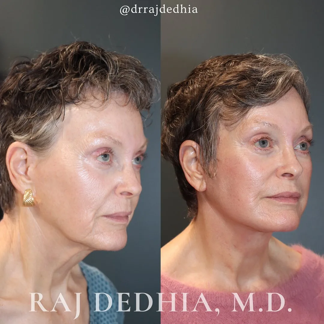 Before and after deep plane facelift — 70-year-old woman, three-quarter view, 3mo post-op by Dr. Raj Dedhia