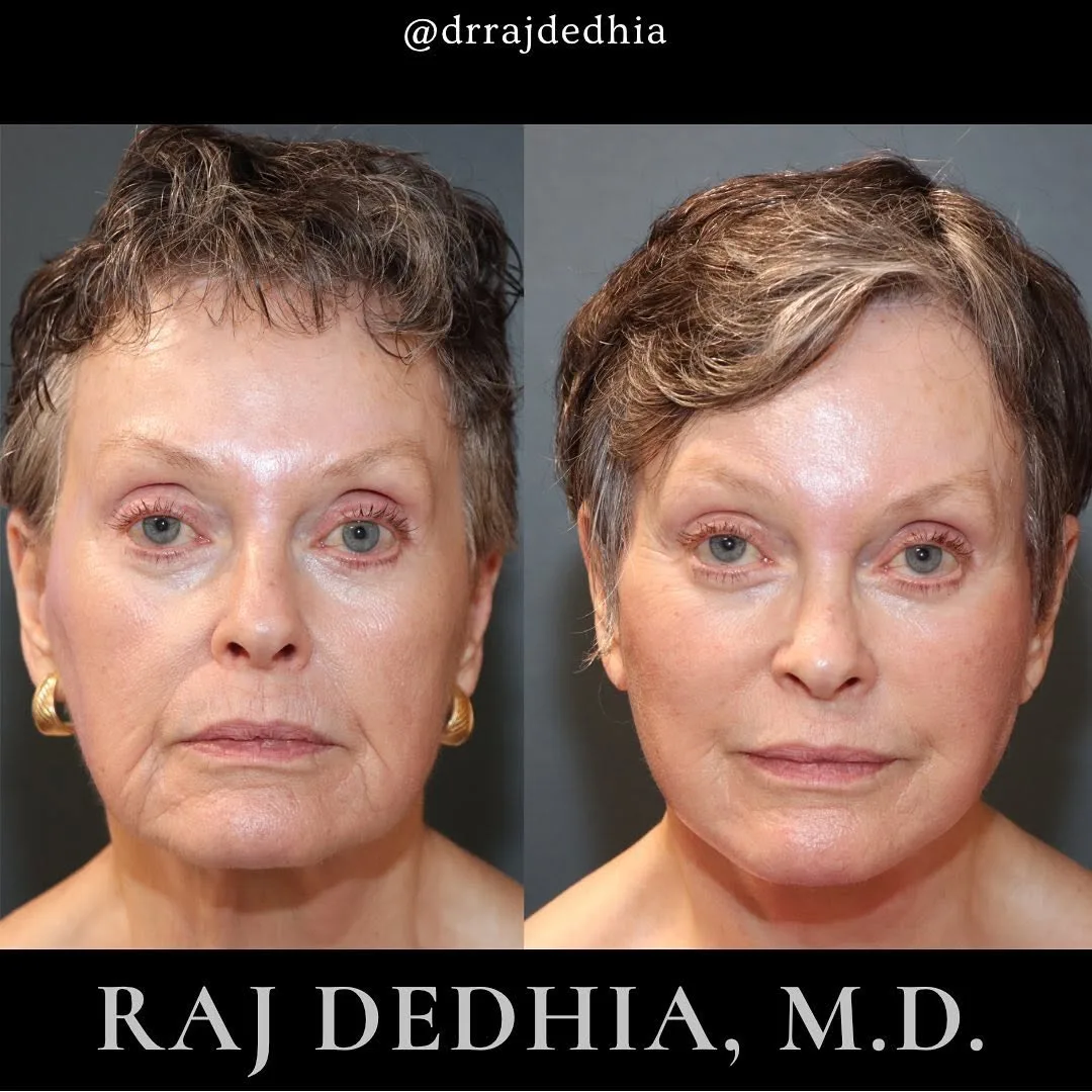 Before and after deep plane facelift — 70-year-old woman, frontal view, 3mo post-op by Dr. Raj Dedhia