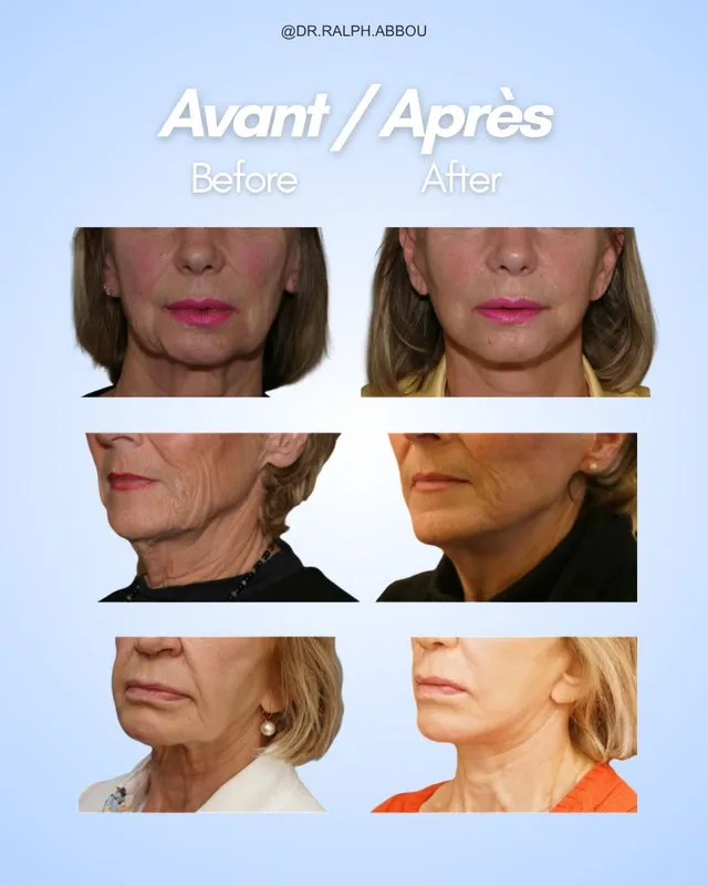 Before and after — Dr. Ralph Abbou