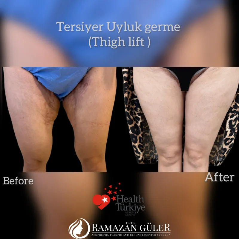 Before and after — Dr. Ramazan Güler