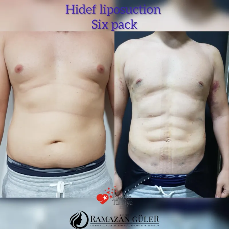Before and after — Dr. Ramazan Güler