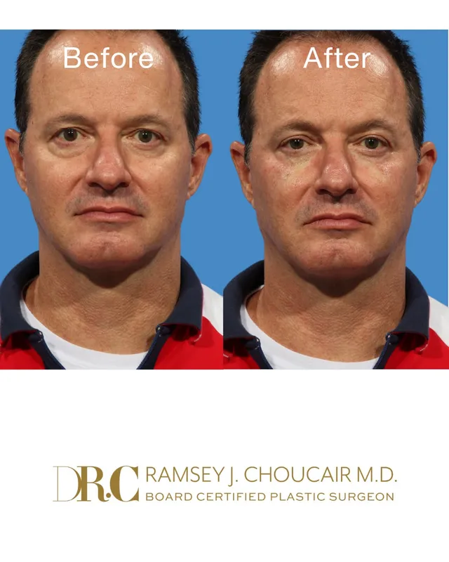 Before and after deep plane facelift, frontal view by Dr. Ramsey Choucair