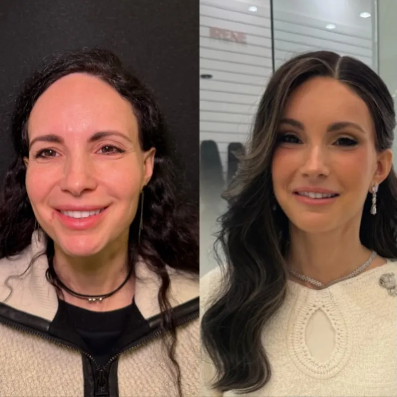 Before and after — Dr. Ramtin Kassir