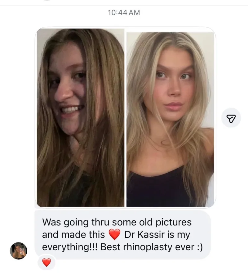 Before and after — Dr. Ramtin Kassir