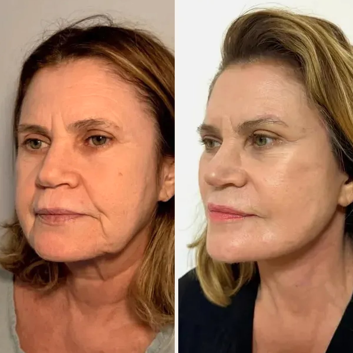 Before and after: Dr. Raulino Brasil