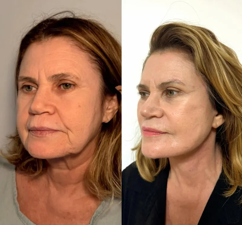 Before and after deep plane facelift, frontal view by Dr. Raulino Brasil